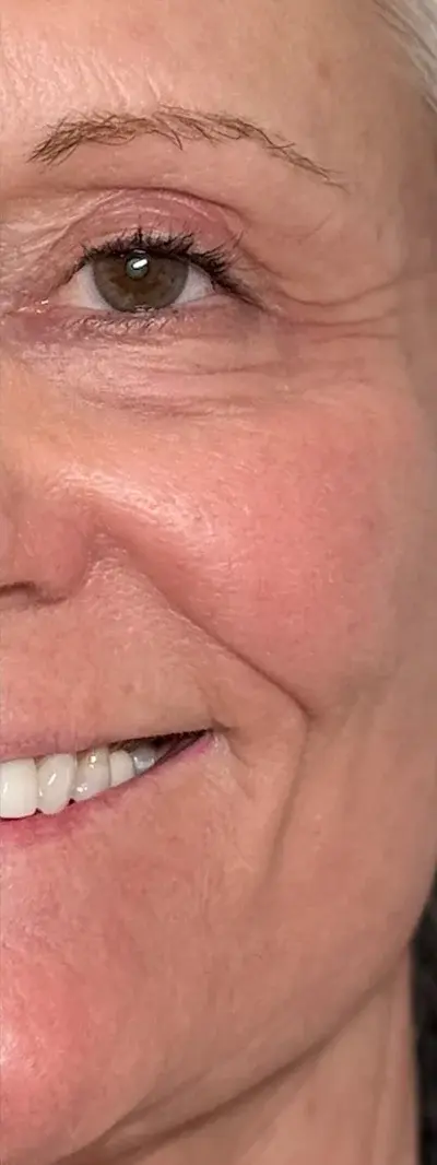 After: Dysport - 40 units