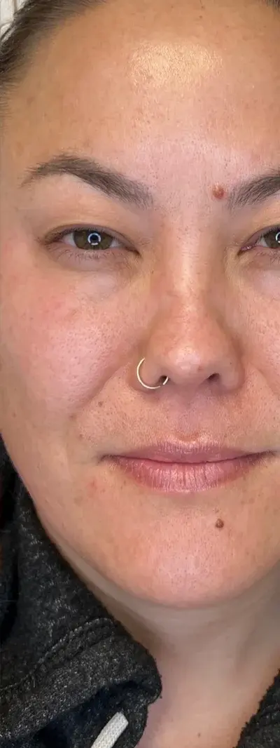 After: Dysport - 50 units