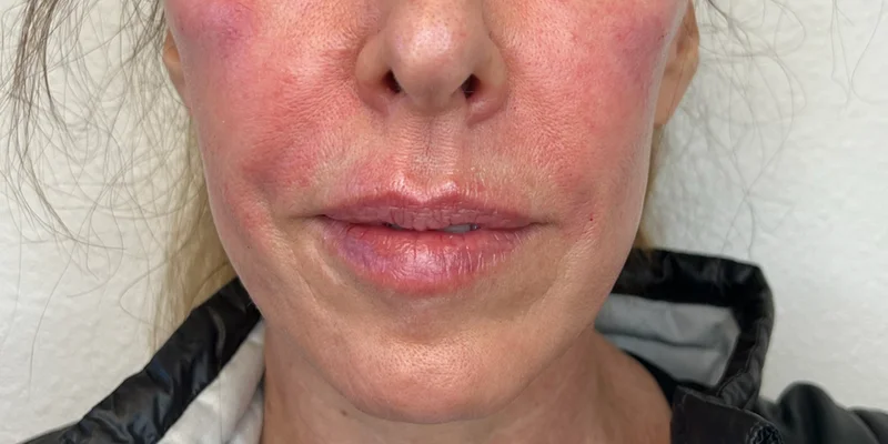 After: Dermal Filler