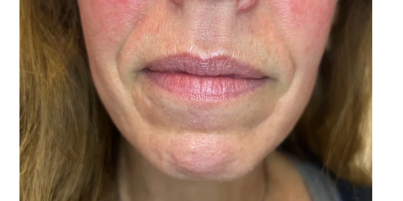 Before: Dermal Filler