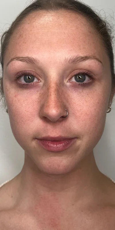 Before: Dermal Filler