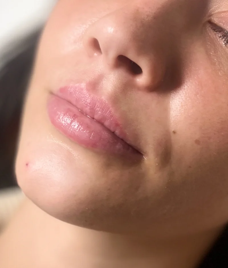 Before: Lip Filler - 1 syringe