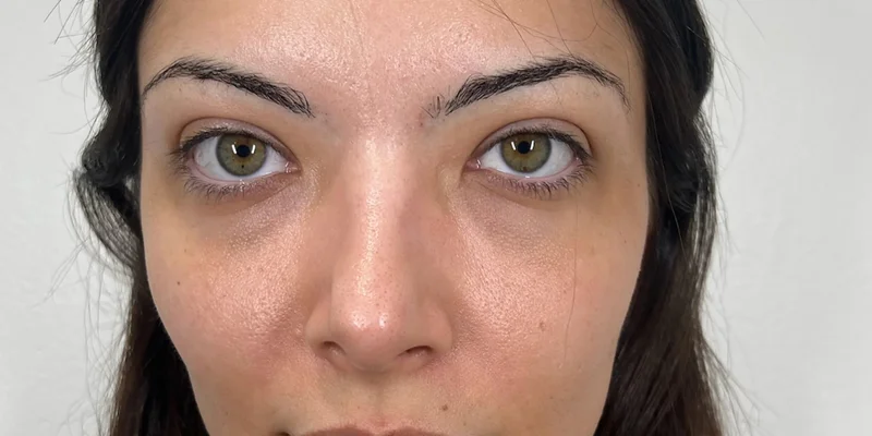 Before: PRF / EZ Gel