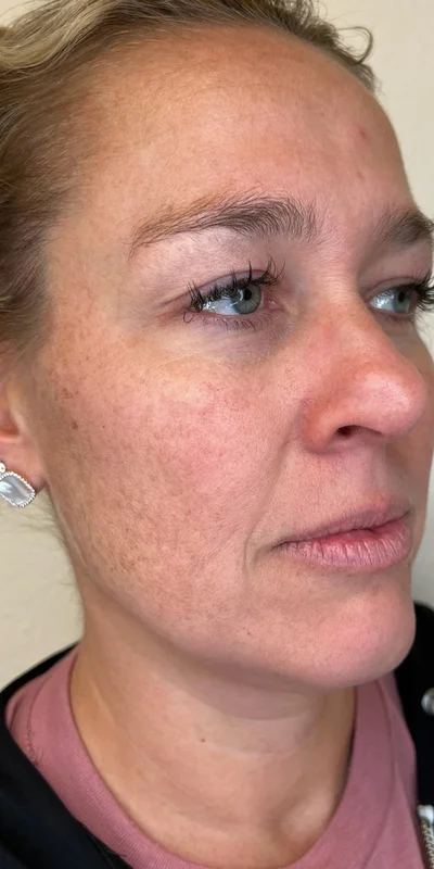 Before: ZO Skin Health